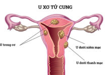 Những dấu hiệu nghi ngờ u xơ tử cung cần đi khám